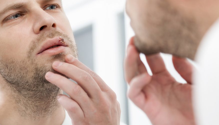 https://www.haushaltstipps.net/wp-content/uploads/hausmittel-gegen-herpes Hausmittel gegen Herpes – 4 Tipps & Tricks