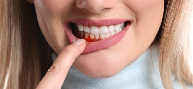 Hausmittel gegen Zahnfleischentzündung: Schmerzen schnell behandeln