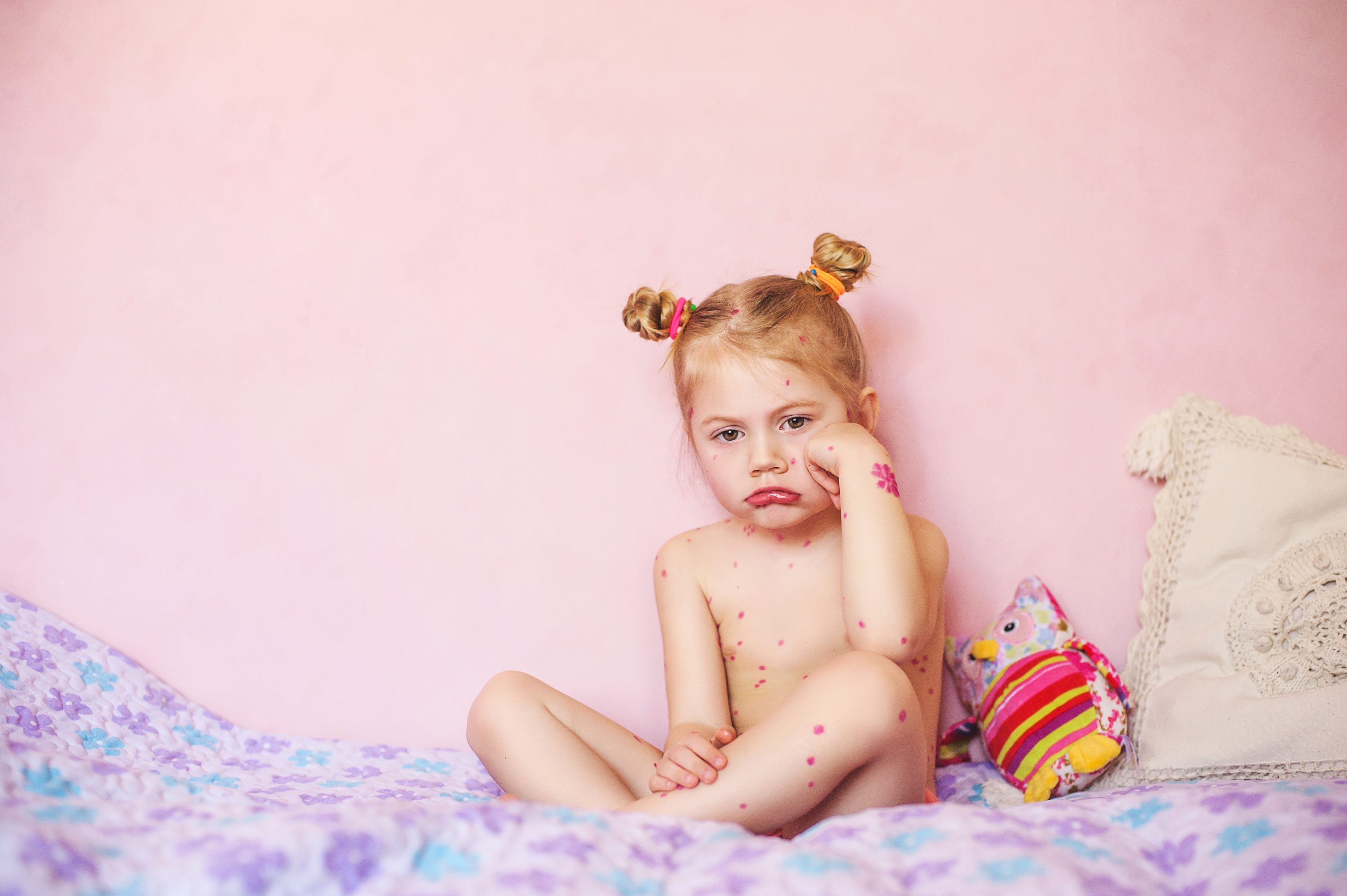 Bekommt man Kinderkrankheiten wirklich nur einmal?