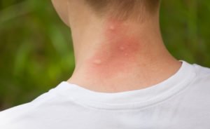 Mückenstiche auf einem Nacken
